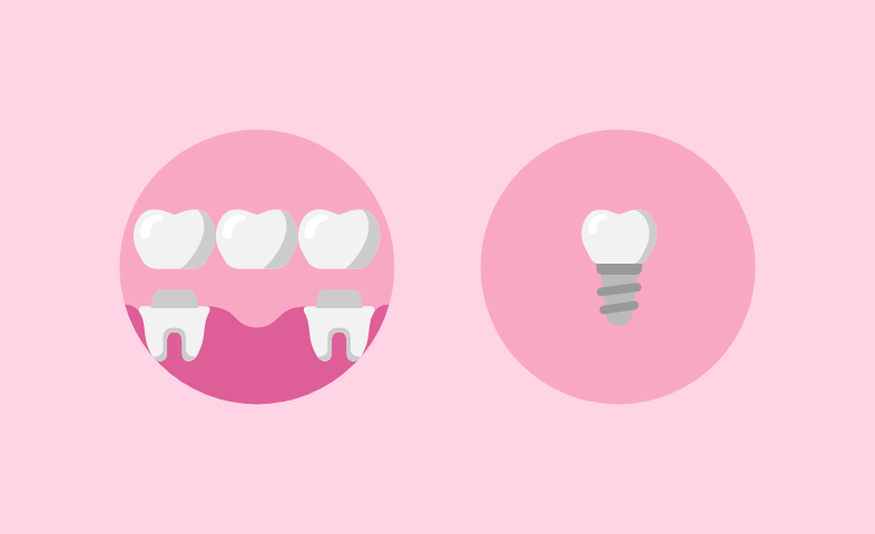 An image showing dental implants vs dental bridges.