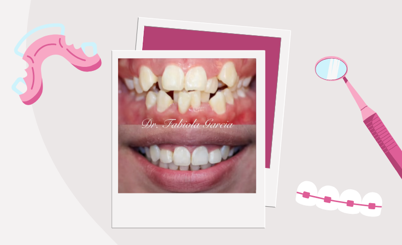 A before and after image of teeth before orthodontic treatment and after.