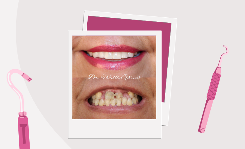 A before and after image of teeth that have been reconstructed.