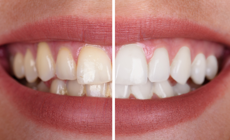 A before and after image of teeth that have had a whitening treatment.