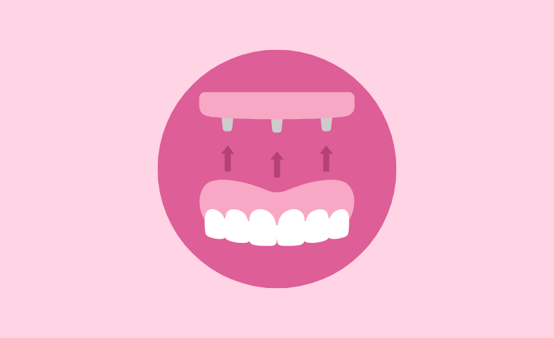 Illustration of All-on-4 dental implants showing white dentures being placed onto pink gums with implants, indicated by arrows, demonstrating full arch teeth replacement.