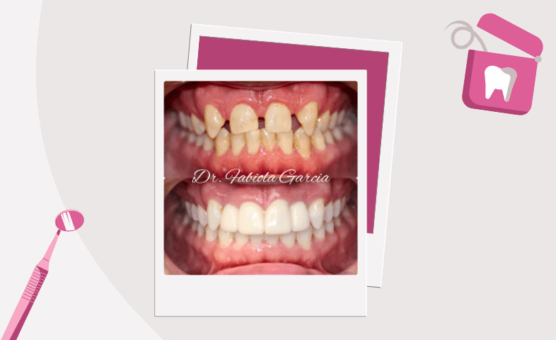 Before and after illustration of full mouth reconstruction showing crooked, missing, and discolored teeth transformed into straight, white teeth using veneers, implants, and braces, with dental mirror and floss graphics.
