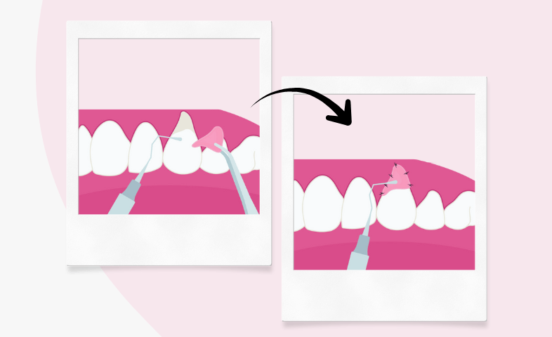 Illustration of gum grafting procedure showing a tooth with an exposed root on the left and the root covered with grafted gum tissue and stitches on the right, connected by a curved arrow, with dental instruments included.