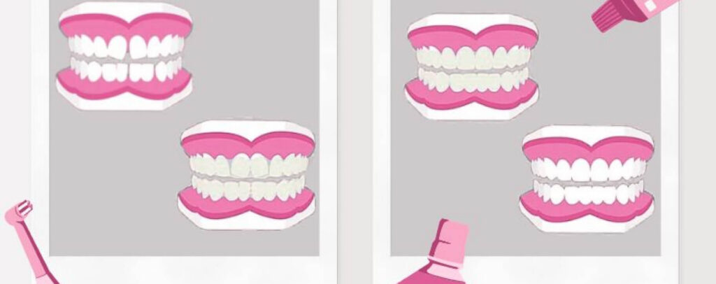 Graphic showing the four phases of clear aligners: crooked teeth, wearing aligners, teeth straightening with aligners, and final straight teeth. Dark pink gums in brand colors and dental hygiene icons highlight care and progress. 
