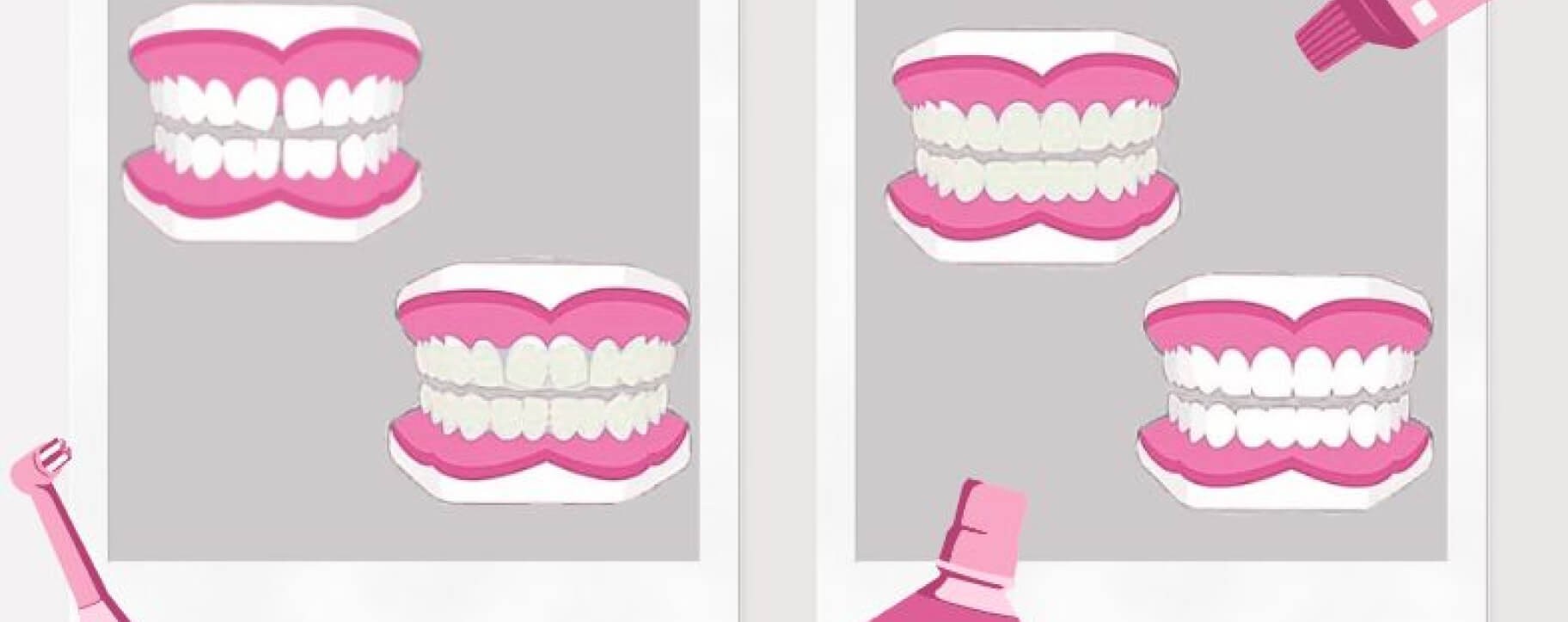 Graphic showing the four phases of clear aligners: crooked teeth, wearing aligners, teeth straightening with aligners, and final straight teeth. Dark pink gums in brand colors and dental hygiene icons highlight care and progress. 