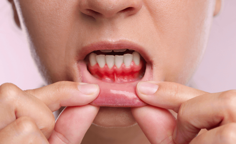 Close-up of a patient’s mouth showing bleeding and inflamed gums, with lower lip pulled down, on a pink background, illustrating gum disease and oral health issues in Houston, TX.